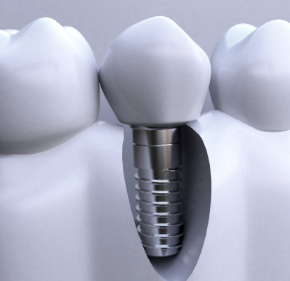 牙科種植體系統dental implant system